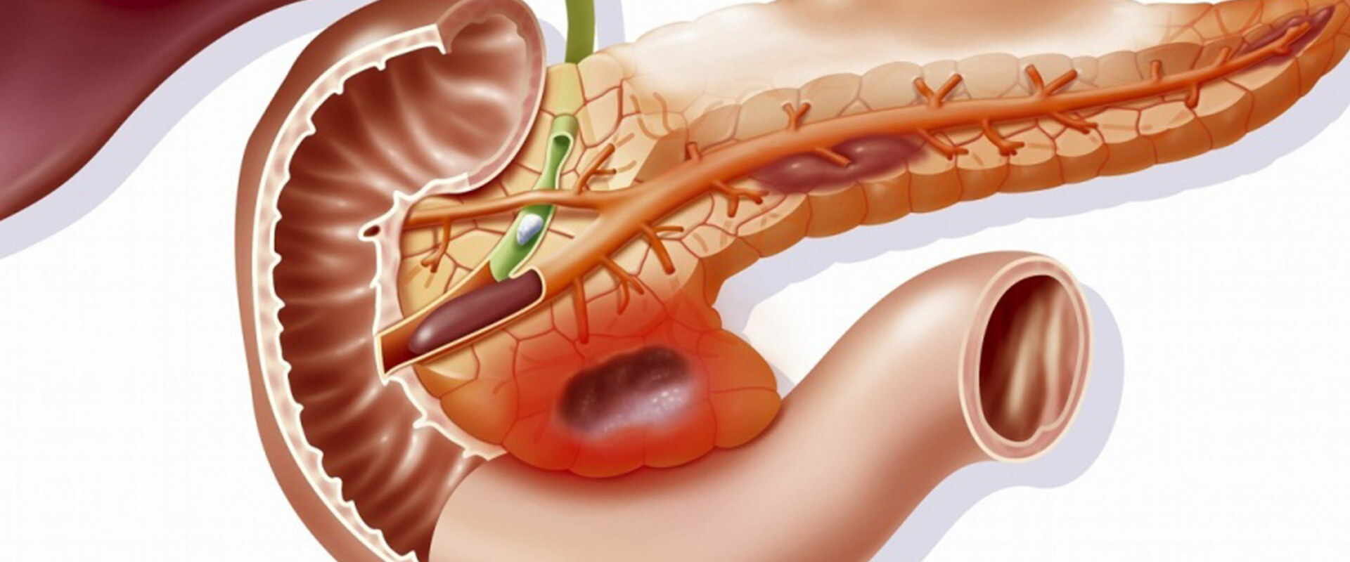 Cistos pancreáticos - Dr. Valter Alvarenga